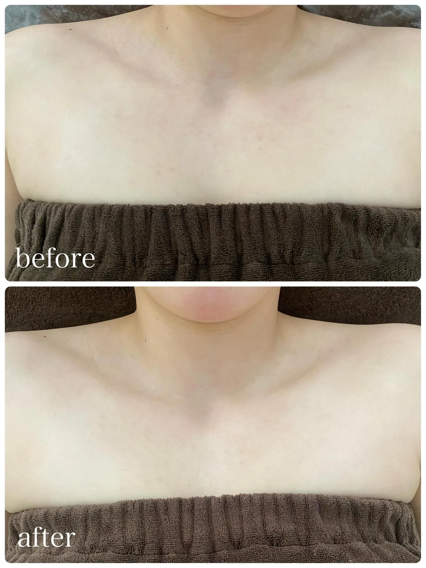 デコルテトリートメント